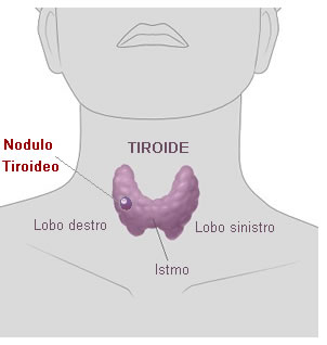 noduli-tiroidei