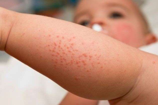 allergia-al-braccio-di-un-bambino